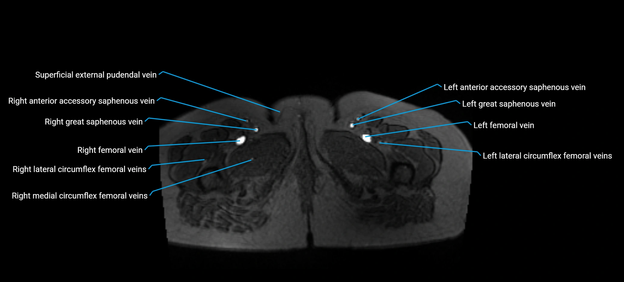 MRV abdomen pelvis & lower limb axial cross sectional anatomy labelled MRI image 206 (1).webp